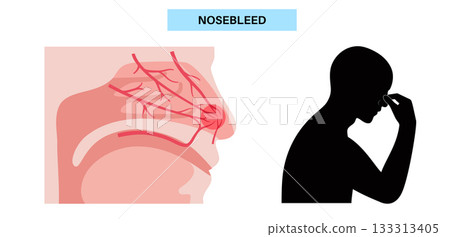 Stop nosebleed instruction Stop nosebleed instruction 133313405