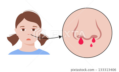 Nosebleed medical poster 133313406