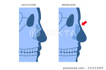 Nasal fracture poster 133313407