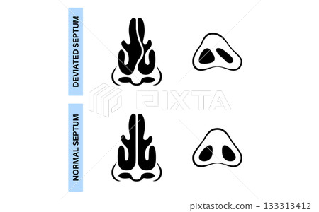Deviated septum poster Deviated septum poster 133313412