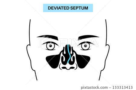 Deviated septum poster Deviated septum poster 133313413