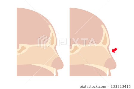 Nasal fracture poster Nasal fracture poster 133313415