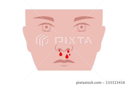 Nosebleed medical poster 133313416