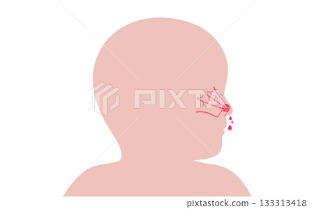 Nosebleed medical poster 133313418