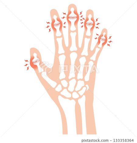 Heberden's nodes: a disease of the finger joints 133358364