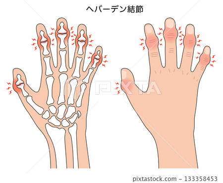 Heberden's nodes: a disease of the finger joints Heberden's nodes: a disease of the finger joints 133358453