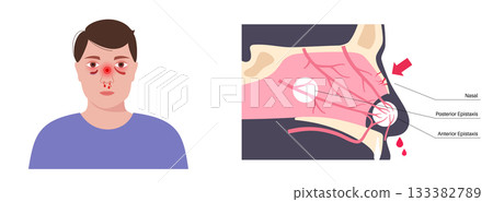 Nasal fracture poster Nasal fracture poster 133382789