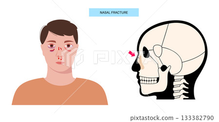 Nasal fracture poster Nasal fracture poster 133382790