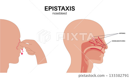 Stop nosebleed instruction Stop nosebleed instruction 133382791