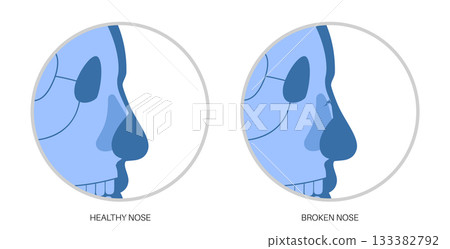 Nasal fracture poster Nasal fracture poster 133382792