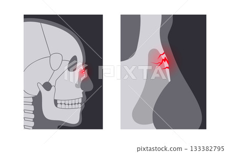Nasal fracture poster Nasal fracture poster 133382795