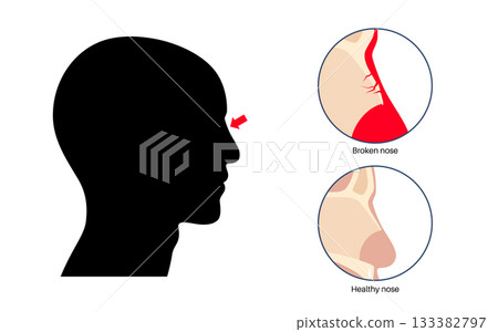 Nasal fracture poster Nasal fracture poster 133382797