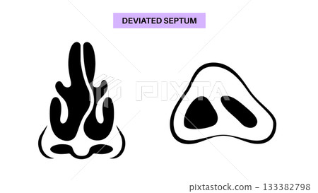 Deviated septum poster Deviated septum poster 133382798