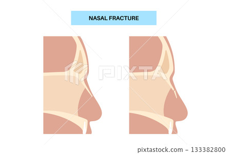 Nasal fracture poster Nasal fracture poster 133382800