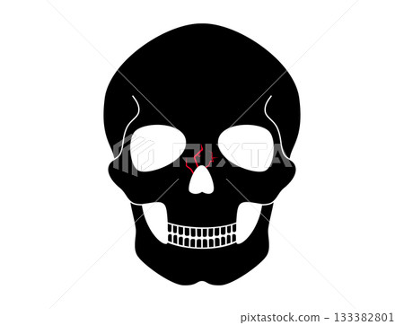 Nasal fracture poster Nasal fracture poster 133382801