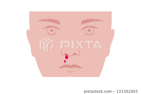 Nosebleed medical poster Nosebleed medical poster 133382803