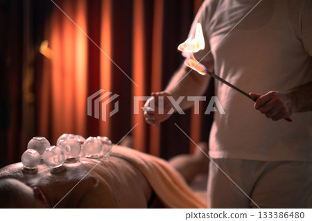 Close up of a traditional fire cupping therapy session with glass cups placed on a patients back and therapist using fire to create suction, promoting relaxation and healing. 133386480