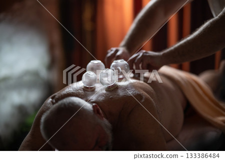 Close up of a traditional fire cupping therapy session with glass cups placed on a patients back and therapist using fire to create suction, promoting relaxation and healing. Close up of a traditional fire cupping therapy session with glass cups placed on a patients back and therapist using fire to create suction, promoting relaxation and healing. 133386484