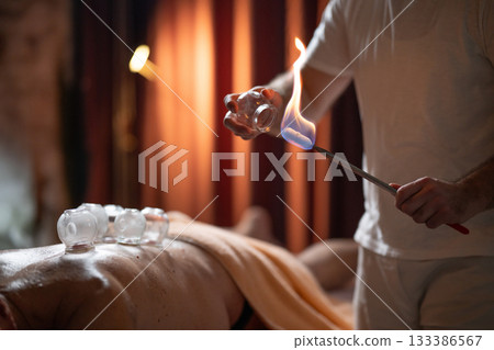 Close up of a traditional fire cupping therapy session with glass cups placed on a patients back and therapist using fire to create suction, promoting relaxation and healing. 133386567