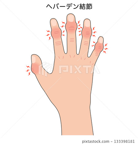 Heberden's nodes: a disease of the finger joints 133398181