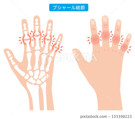 Bouchard's nodes: a disease of the finger joints 133398223