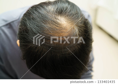 Bald head in man, hair loss treatment health problem. Bald head in man, hair loss treatment health problem. 133401435