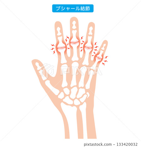 Bouchard's nodes: a disease of the finger joints 133420032