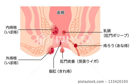 痔瘡的類型 肛門橫切面 痔瘡的類型 肛門橫切面 133420193