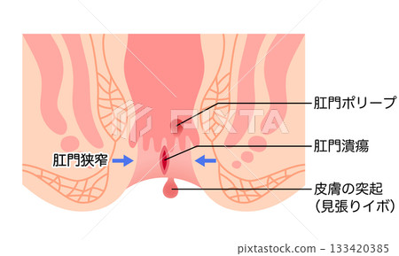 肛裂、痔瘡類型、肛門息肉、肛門橫切面 133420385