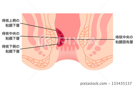 Hemorrhoids - Structure of hemorrhoids - Cross section of the anus 133435137
