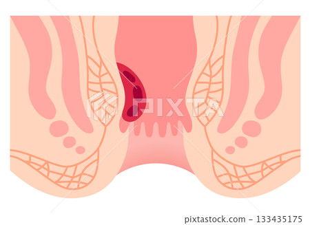 Hemorrhoids - Structure of hemorrhoids - Cross section of the anus 133435175
