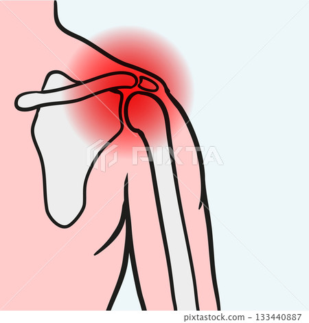 Shoulder pain showing injury or arthritis Shoulder pain showing injury or arthritis 133440887