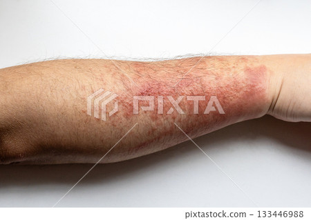 forearm with allergic dermatitis on redness skin 133446988