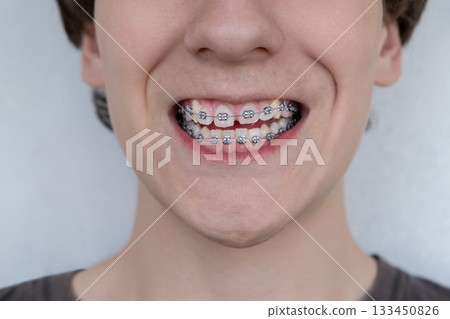 Close-up of a smiling young person with metal dental braces on their teeth. Orthodontic treatment, dental care 133450826