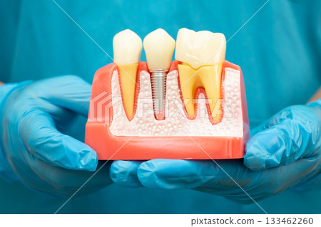Asian dentist holding dental implant, artificial tooth roots into jaw, root canal of dental treatment, gum disease, teeth model for dentist. Asian dentist holding dental implant, artificial tooth roots into jaw, root canal of dental treatment, gum disease, teeth model for dentist. 133462260