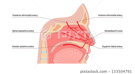 Nosebleed medical poster 133504791