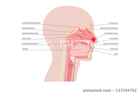 Nosebleed medical poster Nosebleed medical poster 133504792