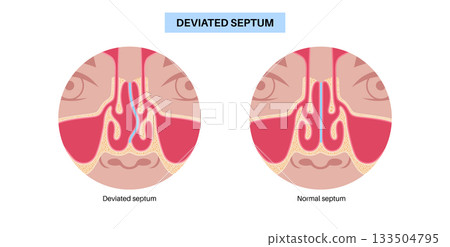 Deviated septum poster 133504795