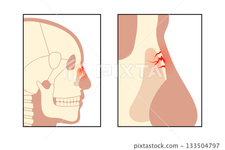 Nasal fracture poster 133504797