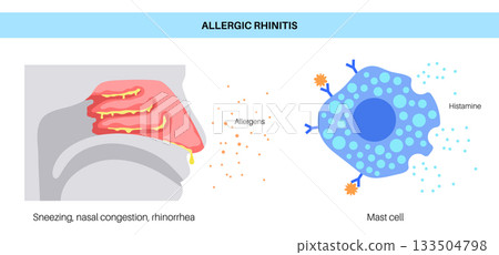 Allergic rhinitis poster Allergic rhinitis poster 133504798