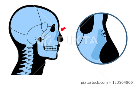 Nasal fracture poster 133504800