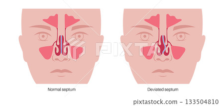 Deviated septum poster Deviated septum poster 133504810