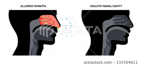 Allergic rhinitis poster 133504811