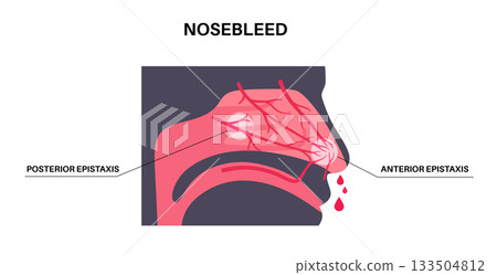 Nosebleed medical poster 133504812