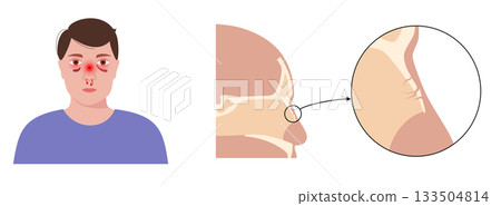 Nasal fracture poster Nasal fracture poster 133504814