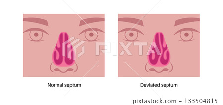 Deviated septum poster 133504815