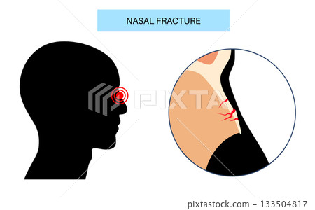 Nasal fracture poster 133504817