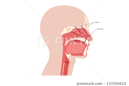 Nosebleed medical poster 133504818