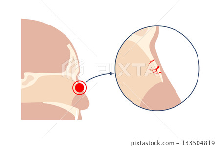 Nasal fracture poster 133504819