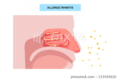 Allergic rhinitis poster 133504820